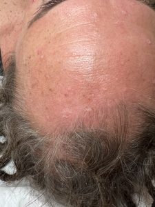 Seborrheic Keratosis Removal Before and After Colchester & Chelmsford