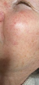 Milia on the cheek of a 78-year-old lady. 