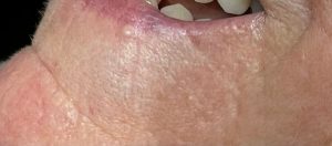 Large Milia on Lip
