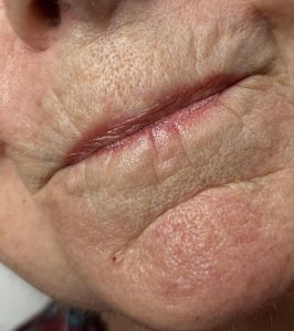 Milia removal Colchester & Chelmsford