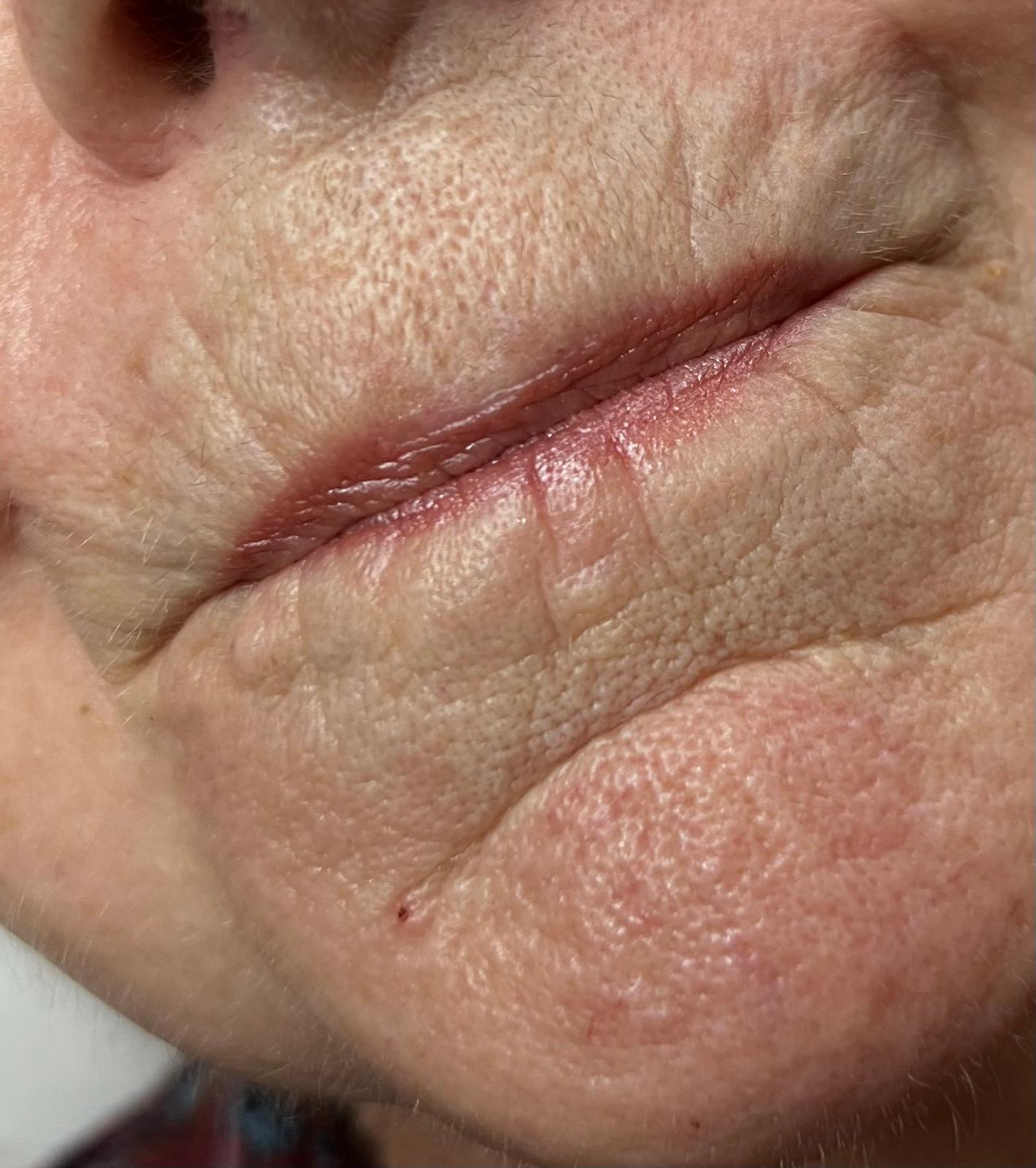 Milia removal Colchester & Chelmsford