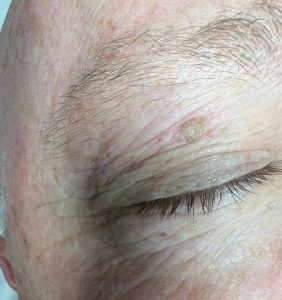 Seborrheic Keratosis on the face removal. Colchester and Chelmsford Clinics.