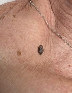 Wart Removal Before & After