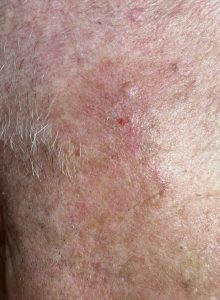 Seborrheic Keratosis on the face removal. Colchester and Chelmsford Clinics.