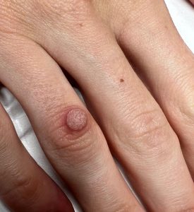Wart Removal Colchester & Chelmsford