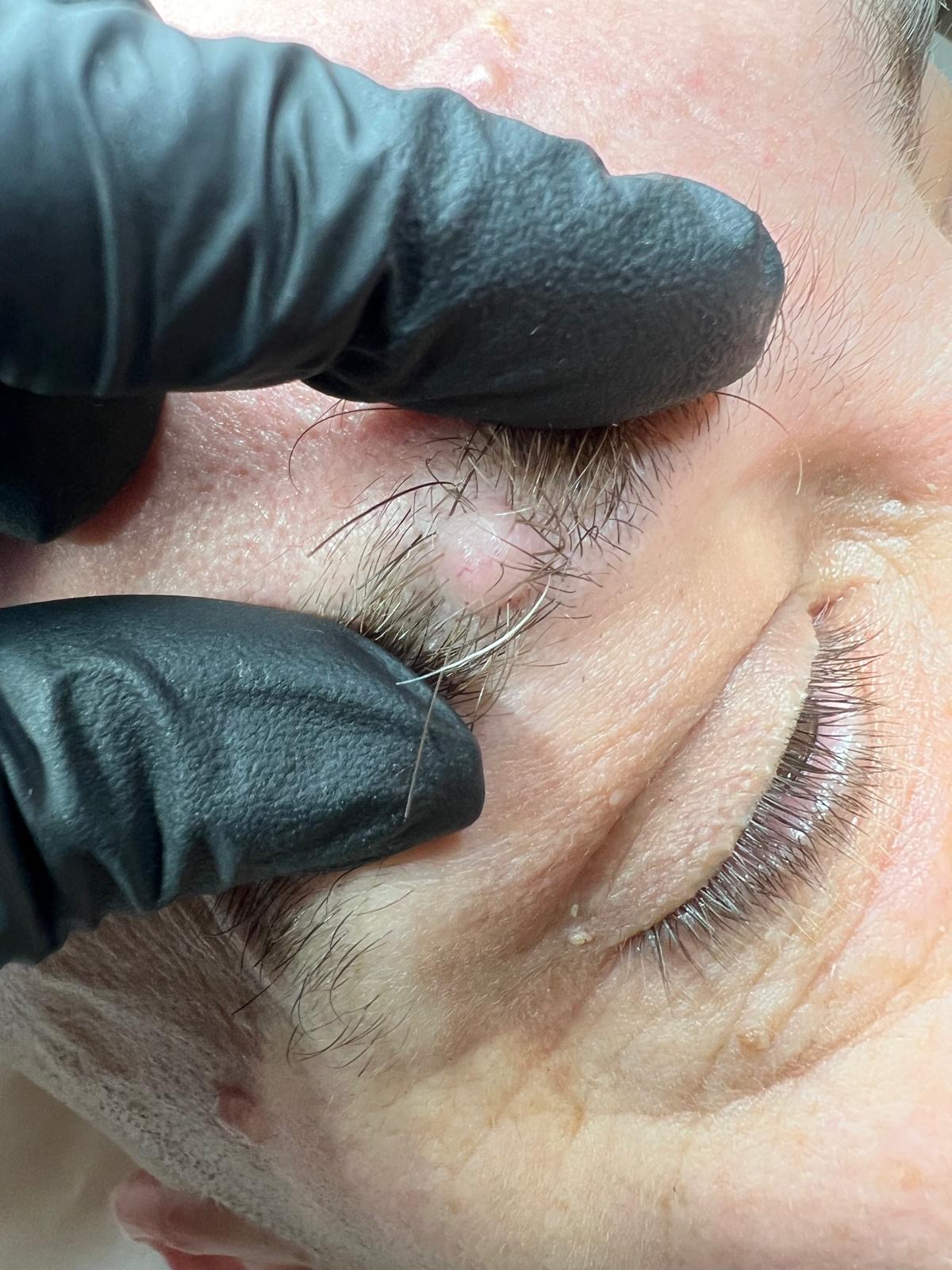 Benign Mole in the Eyebrow