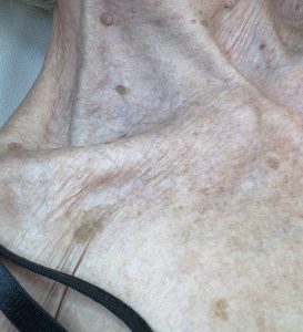 Seborrheic Keratosis Removal Before and After Colchester & Chelmsford