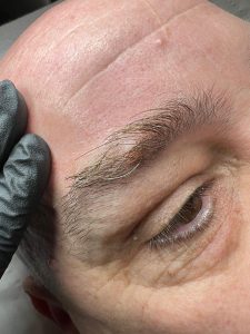 Benign mole in the eyebrow