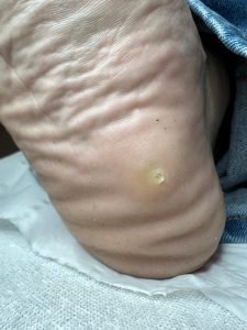Verruca treatment Colchester & Chelmsford 