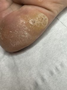 Verruca treatment Colchester & Chelmsford