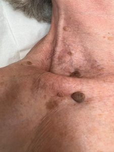 Seborrheic Keratosis Removal Before and After Colchester & Chelmsford
