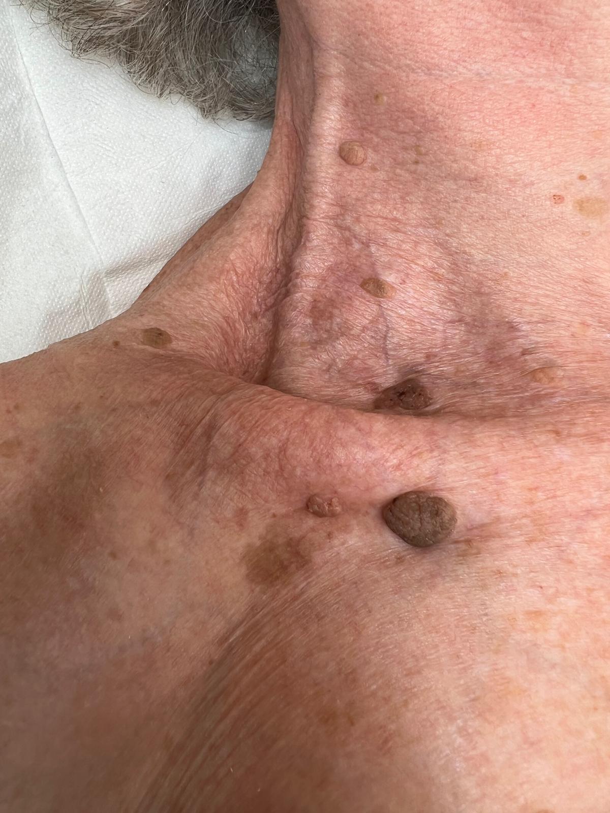Seborrheic Keratosis Removal Before and After Colchester & Chelmsford