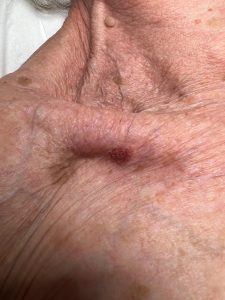 Seborrheic Keratosis Removal Before and After Colchester & Chelmsford