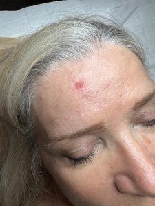 Immediately after Seborrheic Keratosis removal 