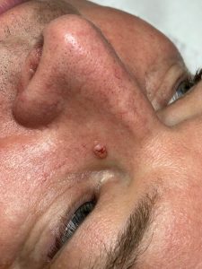 Blemish Removal Before & After Colchester & Chelmsford Clinics