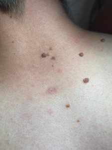Mole Removal Colchester & Chelmsford 