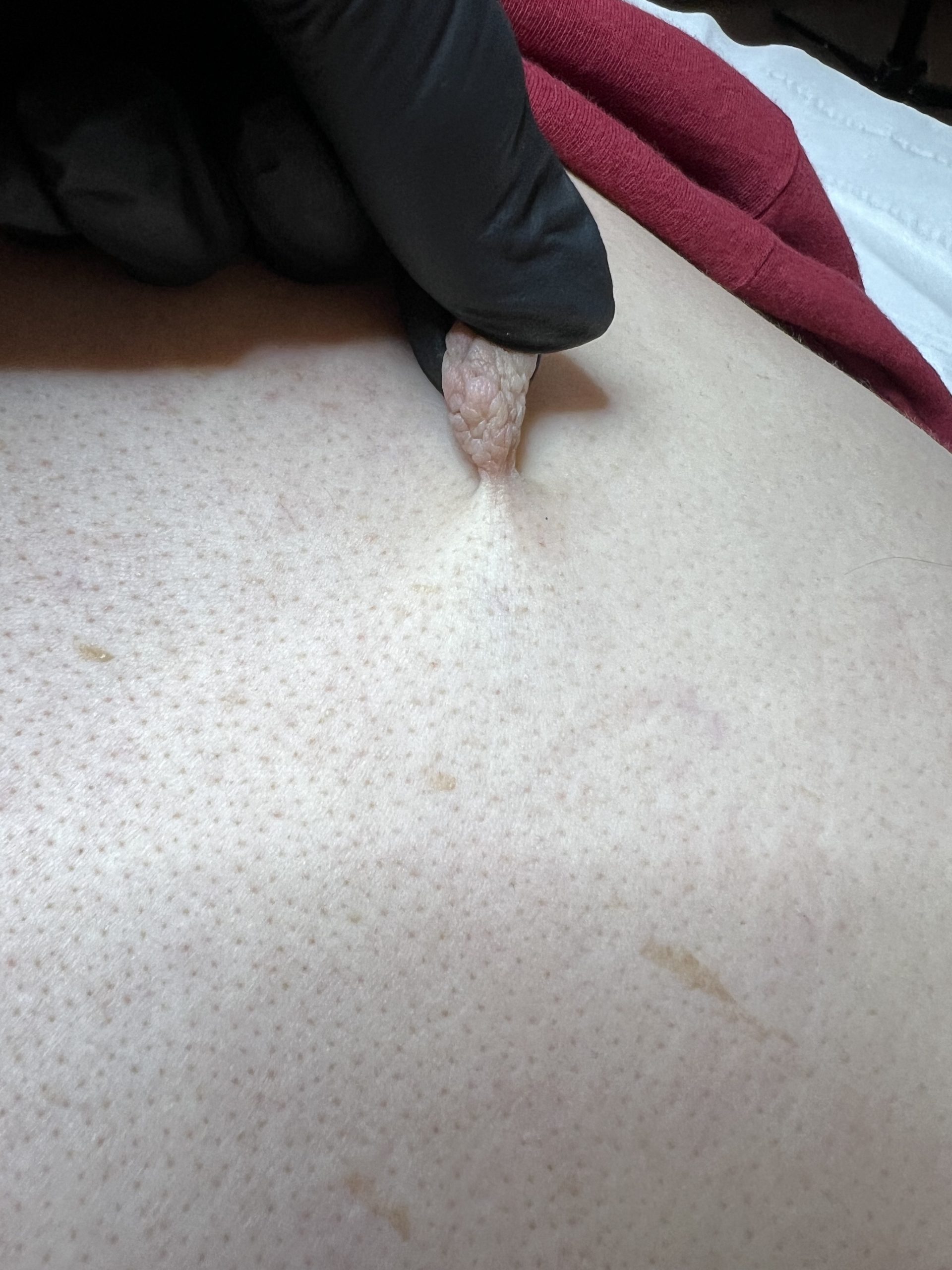 Skin Tag Removal Colchester & Chelmsford