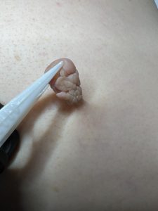 Skin Tag Removal Colchester & Chelmsford