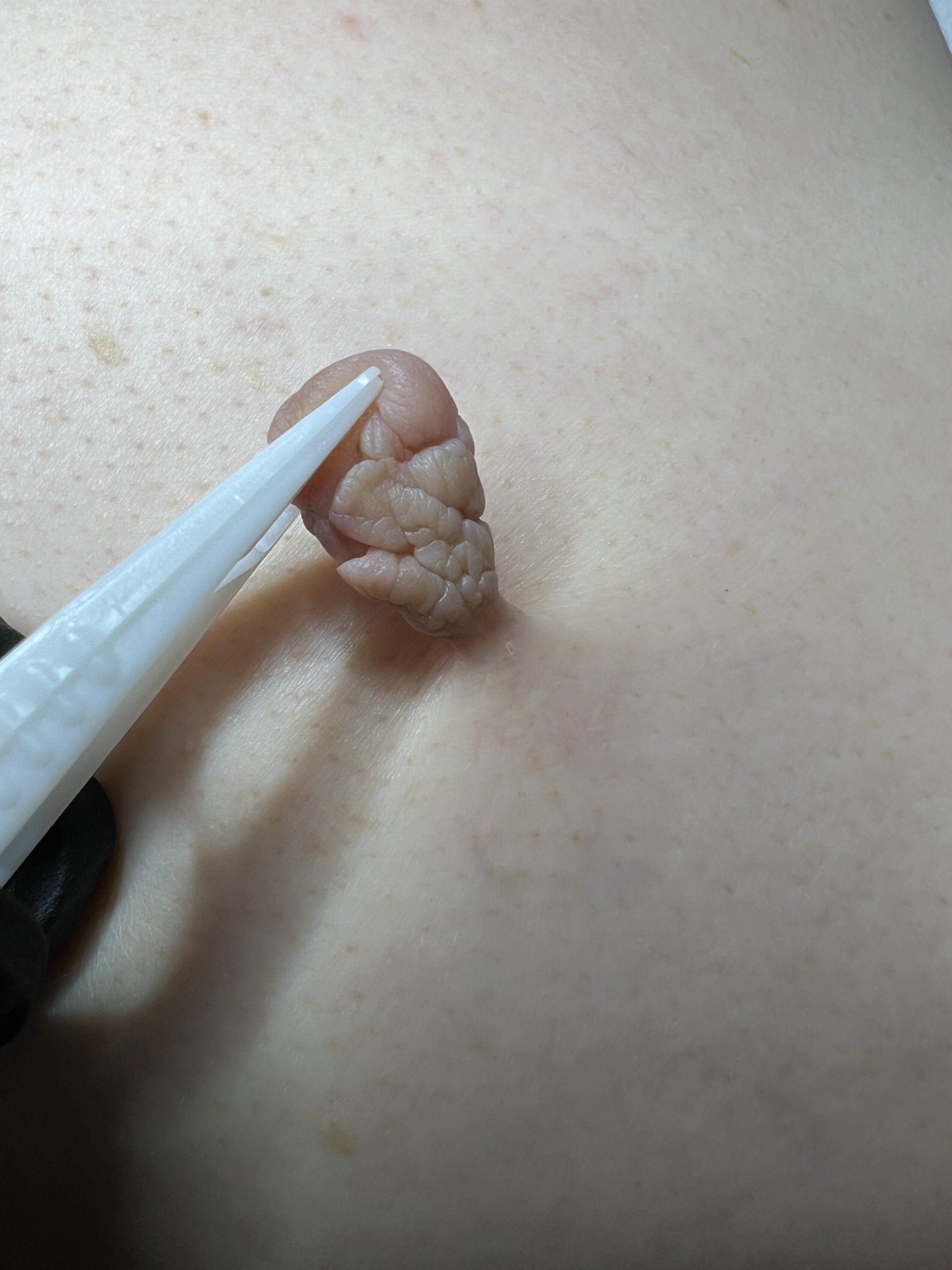 Skin Tag Removal Colchester & Chelmsford