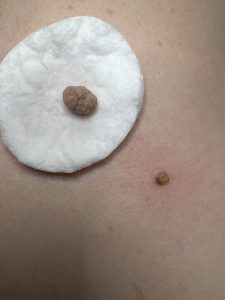 Skin Tag Removal Colchester & Chelmsford