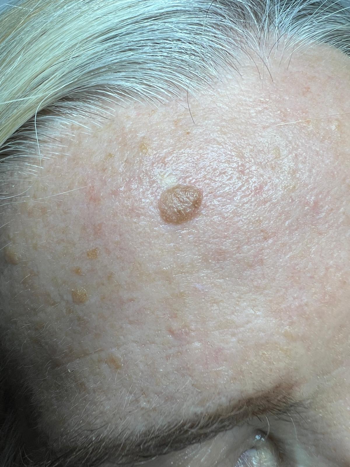 Seborrheic Keratosis Removal Colchester & Chelmsford clinics