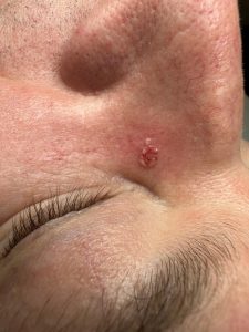 Blemish Removal Before & After Colchester & Chelmsford Clinics