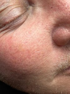 Filiform Wart Before & After 