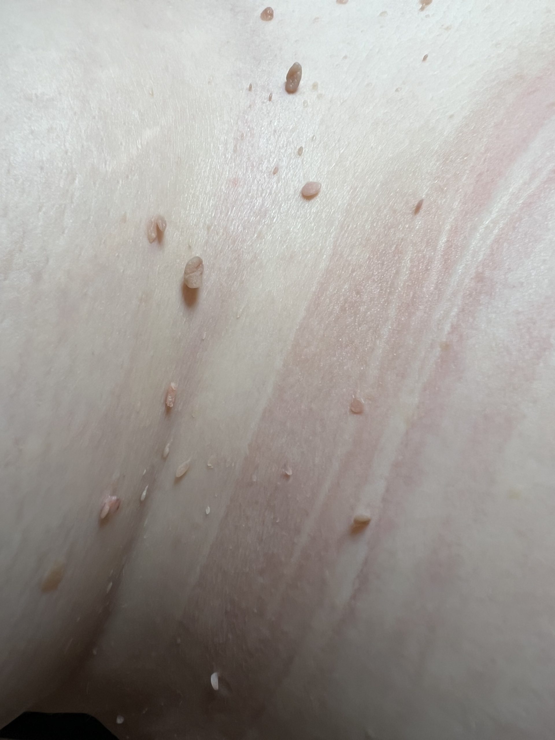 What causes skin tags and what are they made up of?