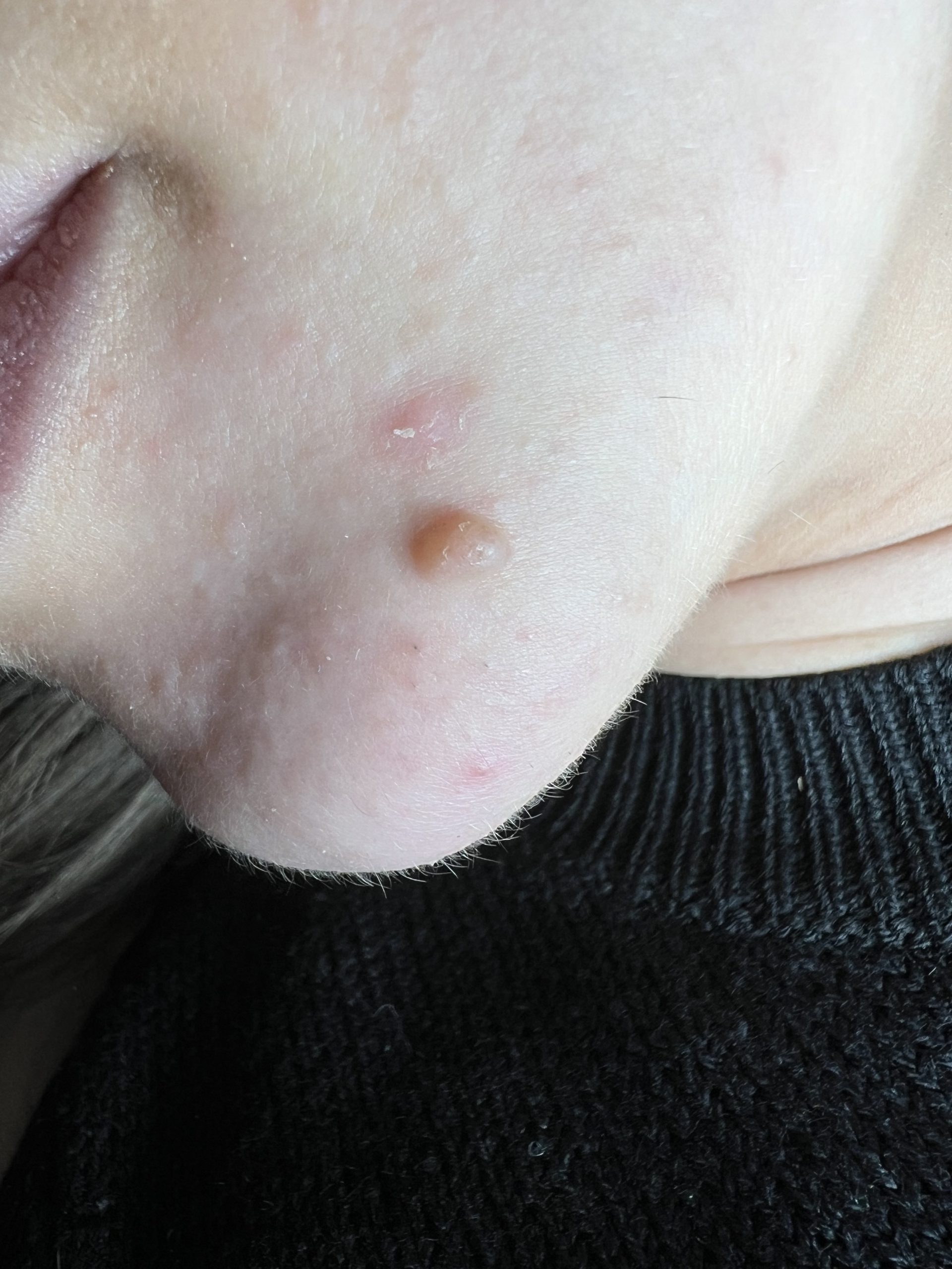 The Importance of Getting Your Mole Checked Before Treatment