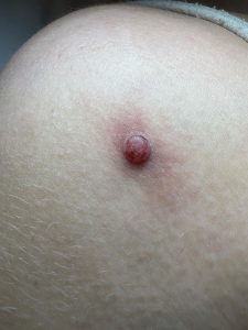 Cherry Angioma