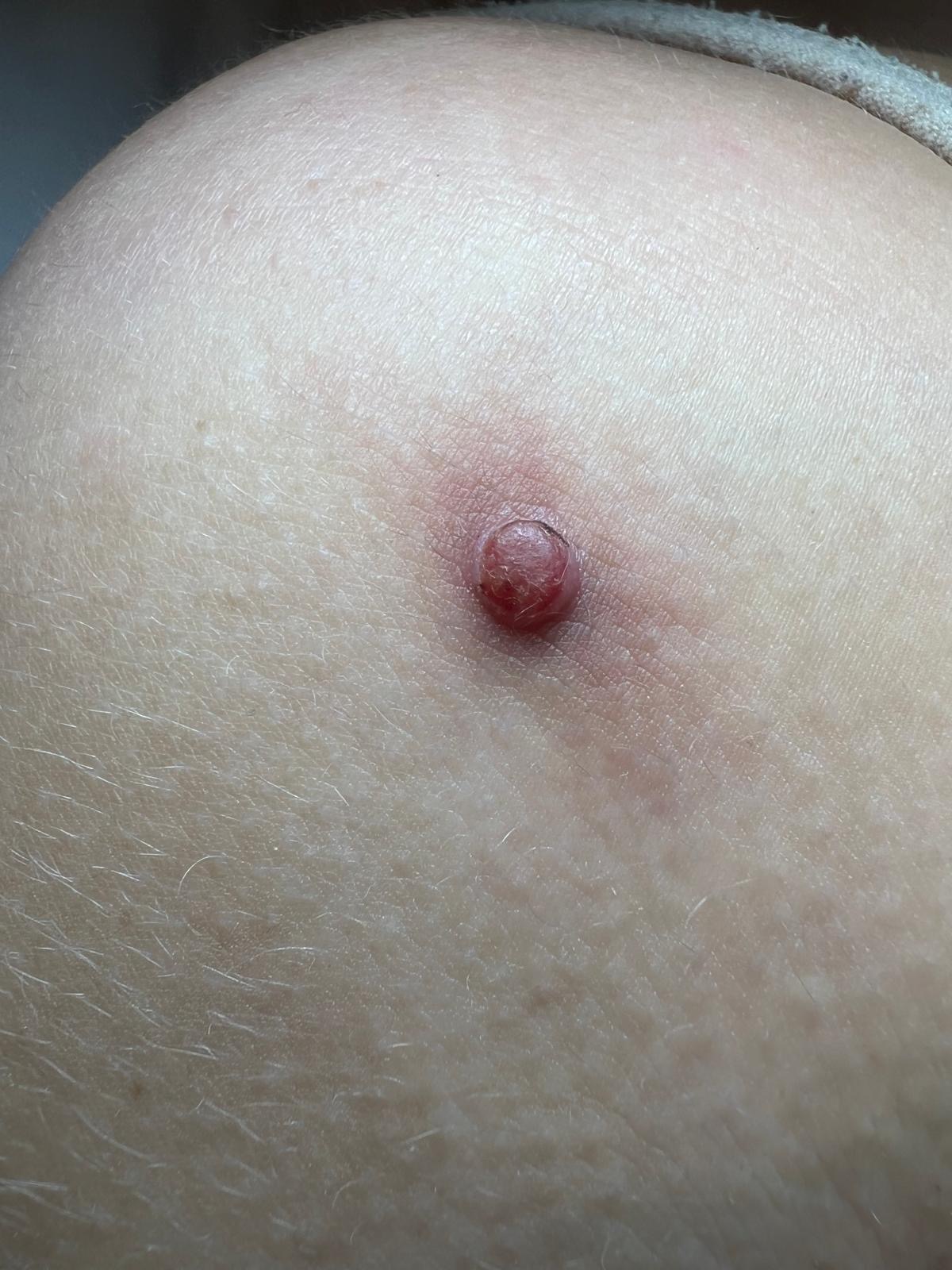 Cherry Angioma