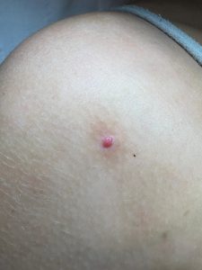 Cherry Angioma treatment Colchester & Chelmsford 