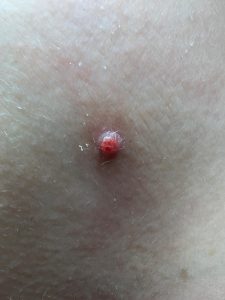 Cherry Angioma treatment Colchester & Chelmsford