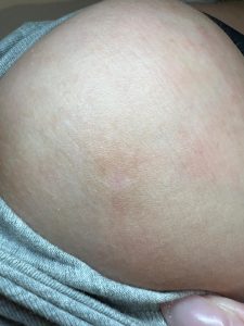 Blood Spot before & after