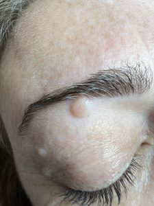 Mole Removal Colchester & Chelmsford