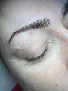 Mole Removal 