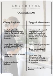 Cherry Angioma or Pyogenic Granuloma
