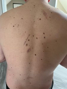 Introducing Mole & Blemish Checks Colchester & Chelmsford