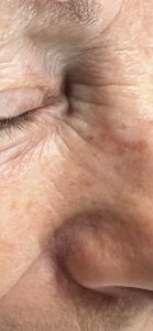Actinic Keratosis