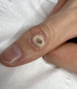 Wart on Thumb Colchester & Chelmsford