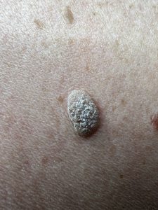 Seborrheic Keratosis Colchester & Chelsmford Clinics