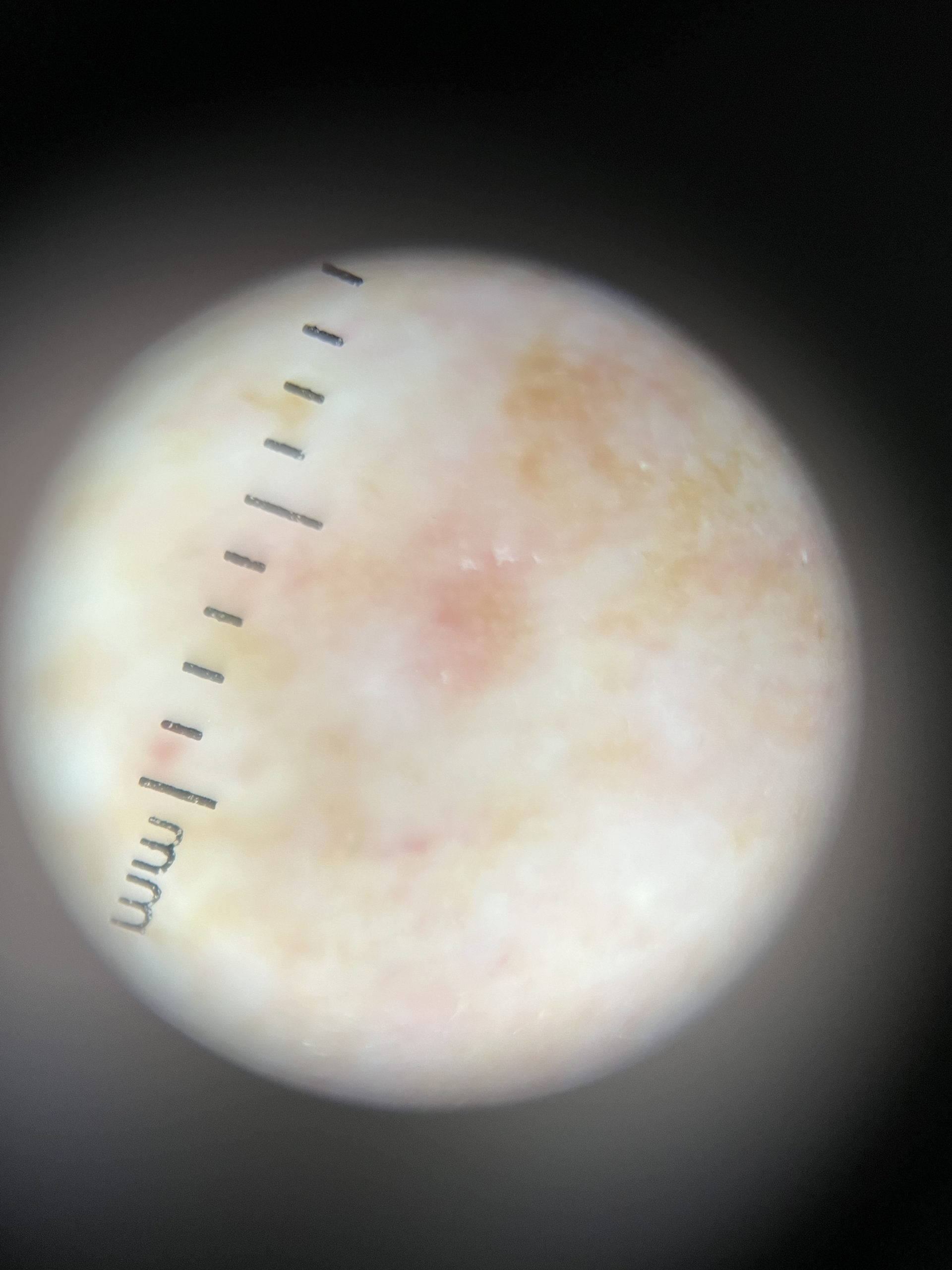 Actinic Keratosis