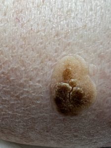 Seborrheic Keratosis Colchester & Chelsmford Clinics