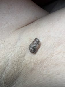 Seborrheic Keratosis Colchester & Chelsmford Clinics