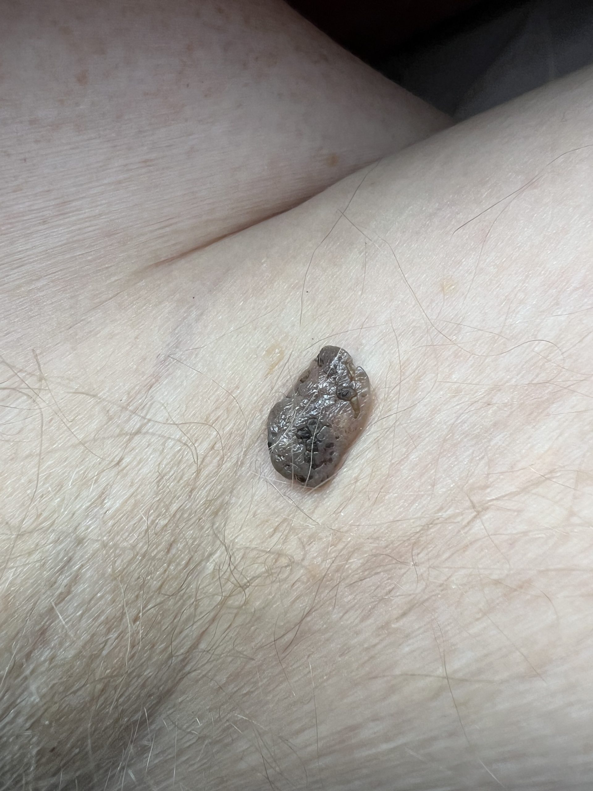 Seborrheic Keratosis Colchester & Chelsmford Clinics
