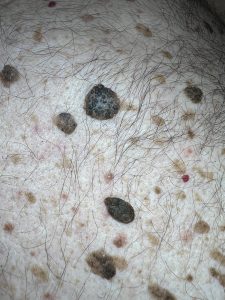 Seborrheic Keratosis Colchester & Chelsmford Clinics