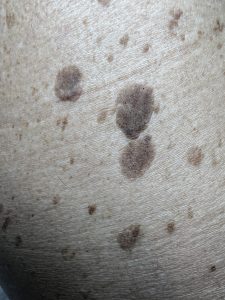 Seborrheic Keratosis Colchester & Chelsmford Clinics