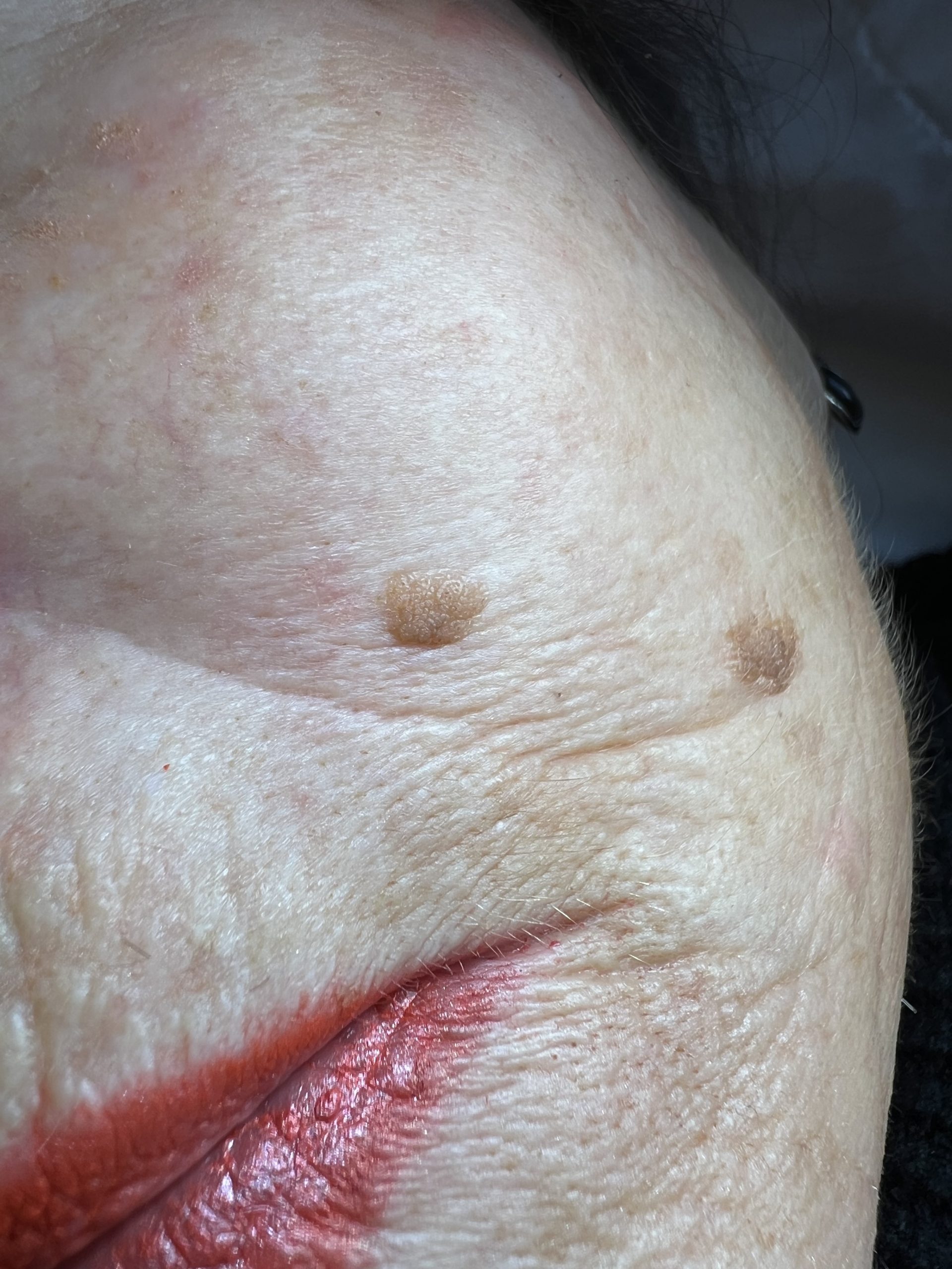 Seborrheic Keratosis face