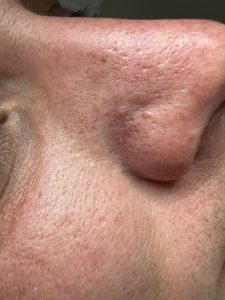 Fibrous Papule Removal, Colchester & Chelmsford
