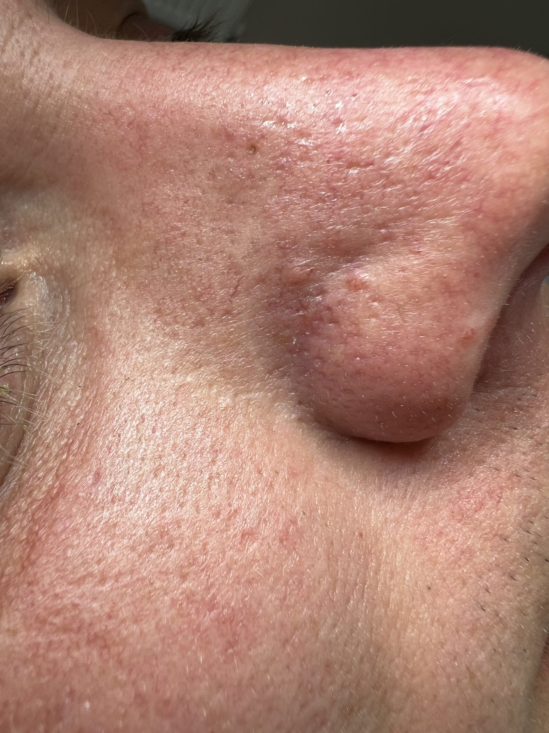 Fibrous Papule Removal, Colchester & Chelmsford